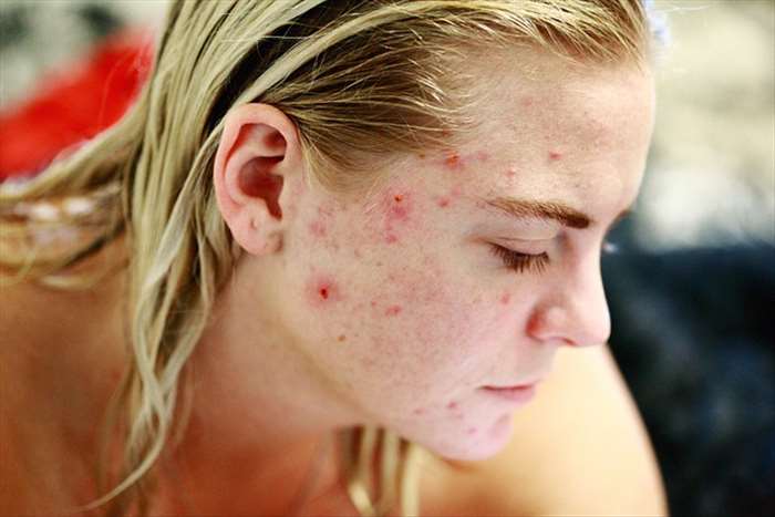 que devez-vous savoir sur l’acné rétentionnelle??  